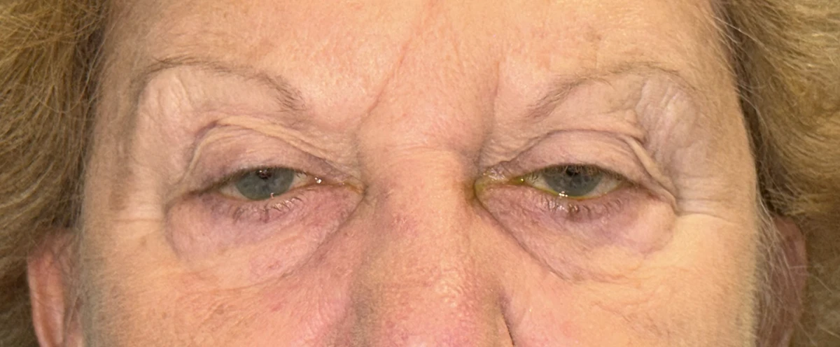 Bilateral upper eyelid blepharoplasty, ptosis repair and limited superior orbicularis myectomy, pre-op 