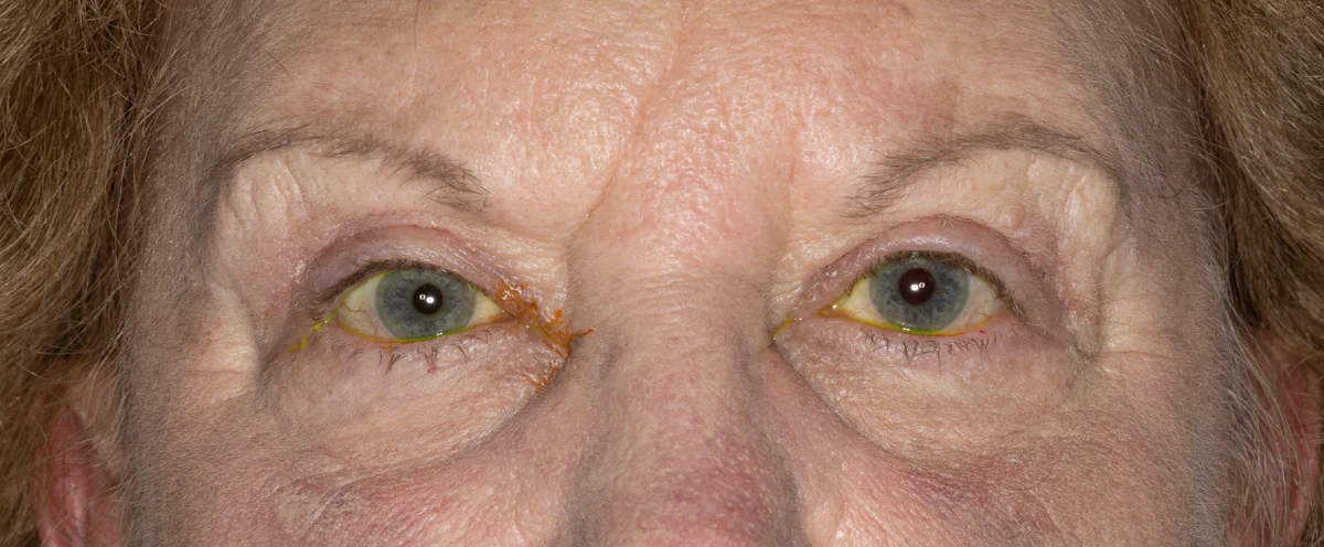 Bilateral upper eyelid blepharoplasty, ptosis repair and limited superior orbicularis myectomy, 3 months post-op