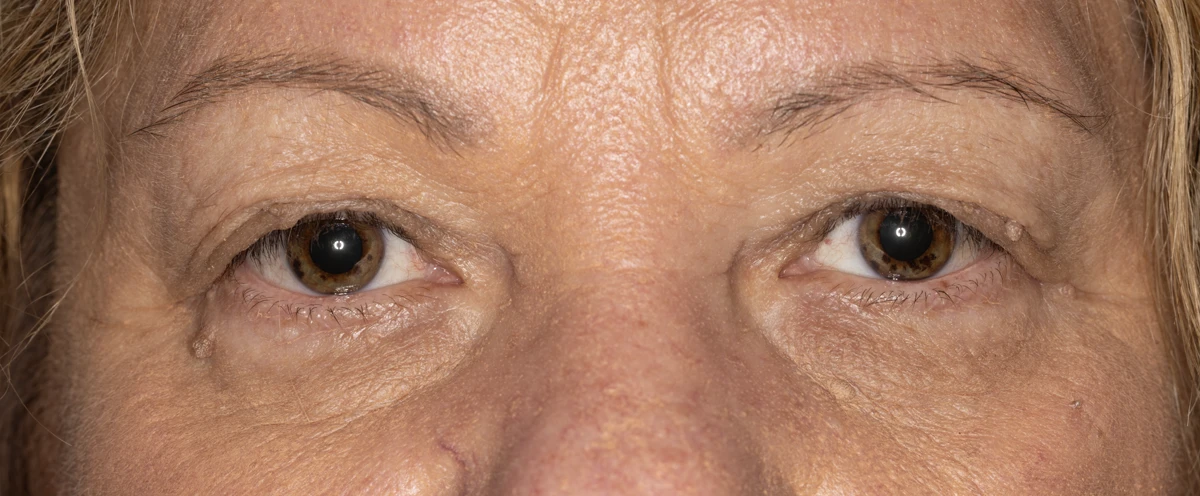 Bilateral upper eyelid blepharoplasty, pre-op