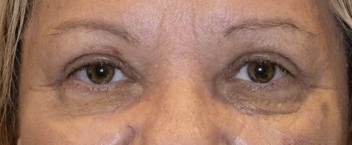 Bilateral upper eyelid blepharoplasty, 1 week post-op