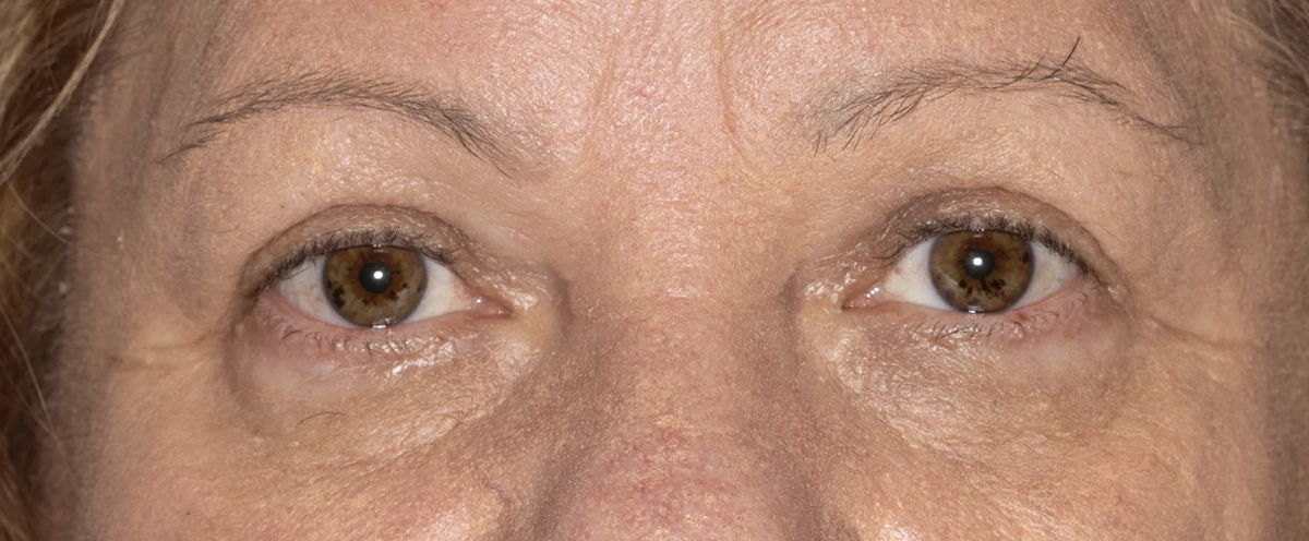 Bilateral upper eyelid blepharoplasty, 3 months post-op