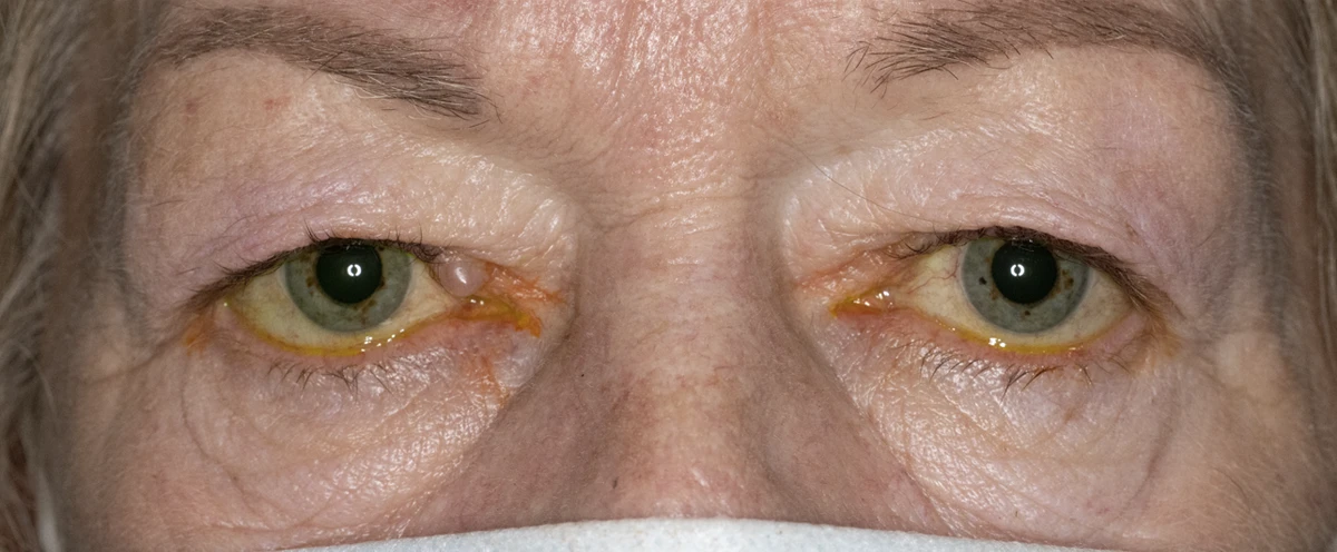 Bilateral upper eyelid blepharoplasty and removal of medial right upper eyelid cyst, pre-op