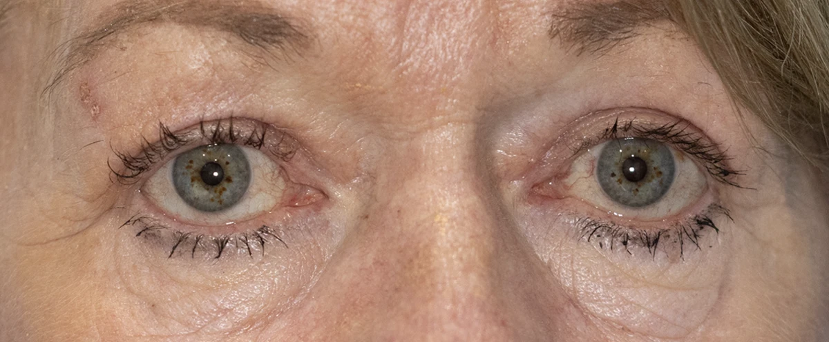 Bilateral upper eyelid blepharoplasty and removal of medial right upper eyelid cyst, 4 months post-op