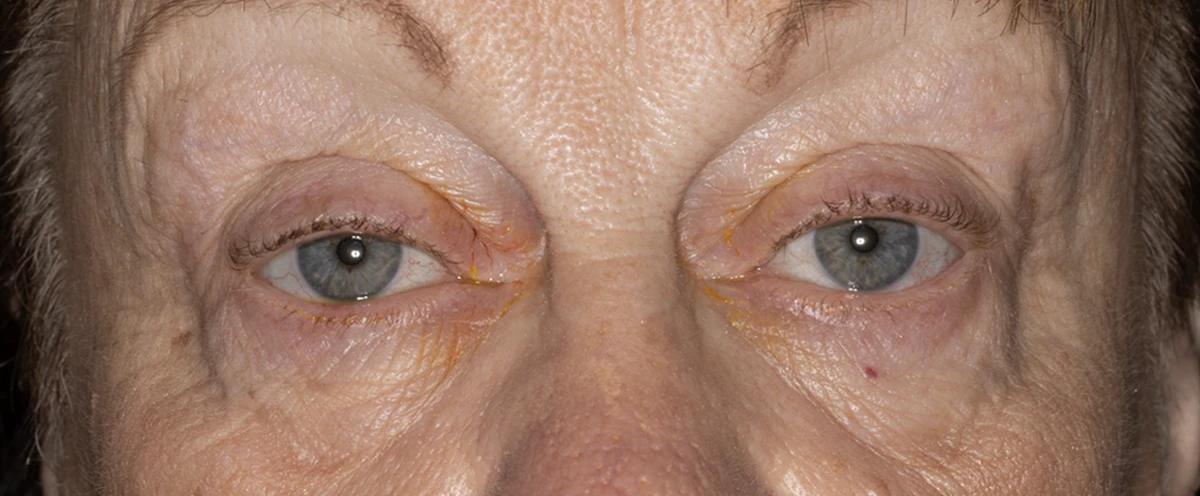 Bilateral upper eyelid blepharoplasty and ptosis repair, pre-op