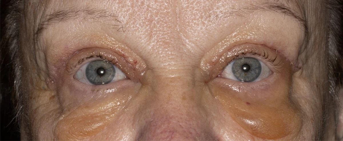 Bilateral upper eyelid blepharoplasty and ptosis repair, 1 week post-op