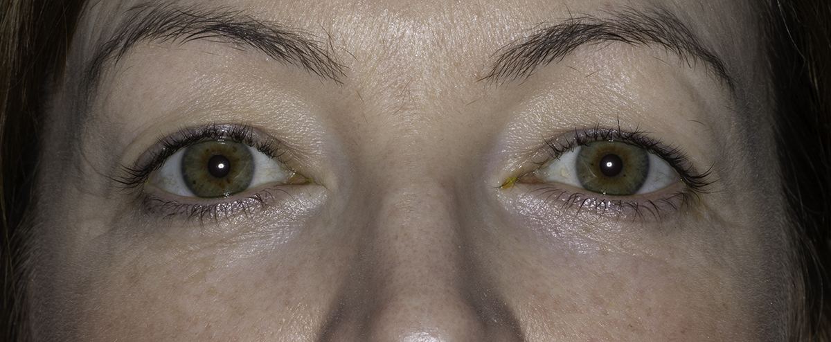 Bilateral upper eyelid blepharoplasty and ptosis repair, pre-op