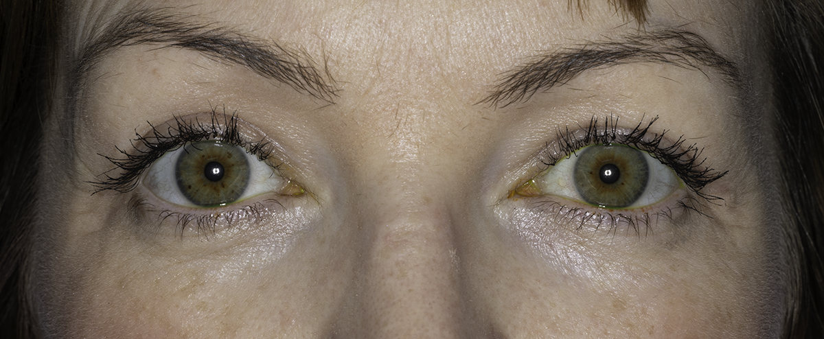 Bilateral upper eyelid blepharoplasty and ptosis repair, 1 week post-op